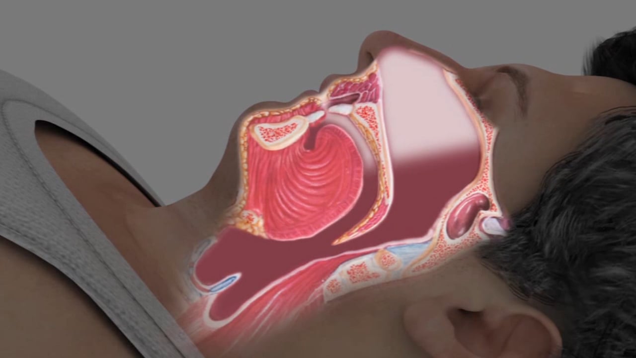 Sleep Apnea Affects 1 in 5 People – Get Tested!